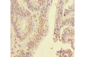 Immunohistochemistry of paraffin-embedded human colon cancer using ABIN7155138 at dilution of 1:100 (HNRNPA2B1 anticorps  (AA 1-249))