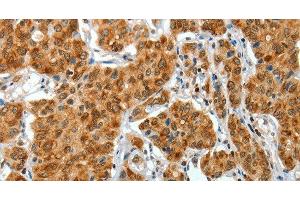 Immunohistochemistry of paraffin-embedded Human lung cancer tissue using COL1A2 Polyclonal Antibody at dilution 1:70