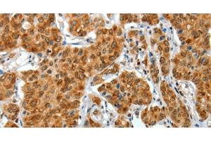 Immunohistochemistry of paraffin-embedded Human lung cancer tissue using COL1A2 Polyclonal Antibody at dilution 1:70 (COL1A2 anticorps)