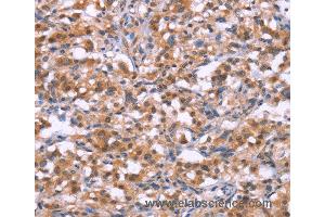 Immunohistochemistry of Human gastric cancer using BRK1 Polyclonal Antibody at dilution of 1:30 (BRK1 anticorps)