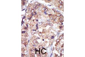 Formalin-fixed and paraffin-embedded human hepatocellular carcinoma tissue reacted with LYN polyclonal antibody  , which was peroxidase-conjugated to the secondary antibody, followed by AEC staining. (LYN anticorps  (N-Term))