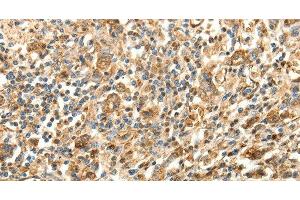 Immunohistochemistry of paraffin-embedded Human gastric cancer using SLC25A11 Polyclonal Antibody at dilution of 1:30 (SLC25A11 anticorps)