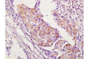 Formalin-fixed and paraffin embedded human lung carcinoma labeled with Anti-CD134 Polyclonal Antibody, Unconjugated  followed by conjugation to the secondary antibody and DAB staining.
