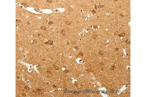 Immunohistochemistry of Human lung cancer using MAP1B  Polyclonal Antibody at dilution of 1:60 (MAP1B anticorps)