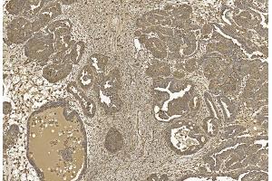 Immunohistochemical analysis of paraffin-embedded Human Ovarian cancer section using Pink1 am1021b. (beta Actin anticorps)