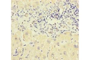 Immunohistochemistry of paraffin-embedded human liver cancer using ABIN7162443 at dilution of 1:100 (P2RX3 anticorps  (AA 44-317))