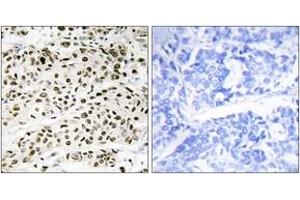 Immunohistochemistry analysis of paraffin-embedded human breast carcinoma tissue, using VPS72 Antibody. (VPS72 anticorps  (AA 131-180))