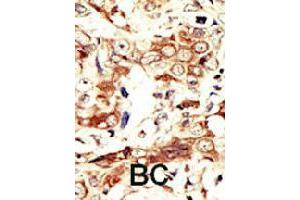 Formalin-fixed and paraffin-embedded human cancer tissue reacted with INSRR polyclonal antibody  , which was peroxidase-conjugated to the secondary antibody, followed by AEC staining.