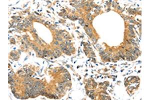 The image on the left is immunohistochemistry of paraffin-embedded Human colorectal cancer tissue using ABIN7192977(UBTD1 Antibody) at dilution 1/30, on the right is treated with synthetic peptide. (UBTD1 anticorps)