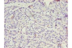 Immunohistochemistry of paraffin-embedded human ovarian cancer using ABIN7142122 at dilution of 1:100 (DPH1 anticorps  (AA 192-318))