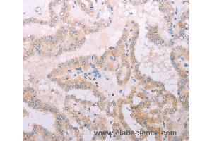 Immunohistochemistry of Human thyroid cancer using TPO Polyclonal Antibody at dilution of 1:50 (TPO anticorps)