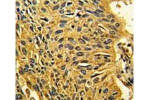 IHC analysis of FFPE human lung carcinoma stained with CDK2 antibody (CDK2 anticorps  (AA 230-260))