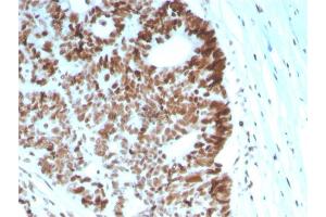 Formalin-fixed, paraffin-embedded human Colon Carcinoma stained with MSH6 Mouse Monoclonal Antibody (MSH6/2927).