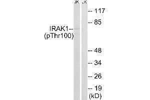 Immunohistochemistry analysis of paraffin-embedded human colon carcinoma tissue using IRAK1 (Phospho-Thr100) antibody. (IRAK1 anticorps  (pThr100))