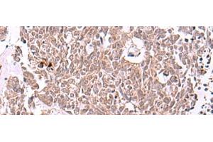 Immunohistochemistry of paraffin-embedded Human lung cancer tissue using IRX4 Polyclonal Antibody at dilution of 1:40(x200) (IRX4 anticorps)