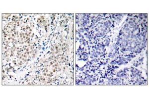 Immunohistochemical analysis of paraffin- embedded human breast carcinoma tissue using Myc (Ab-358) antibody (E021035). (c-MYC anticorps)