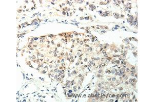 Immunohistochemistry of Human breast cancer using TPM2 Polyclonal Antibody at dilution of 1:60 (TPM2 anticorps)