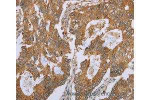 Immunohistochemistry of Human gastric cancer using NLRP10 Polyclonal Antibody at dilution of 1:45 (NLRP10 anticorps)
