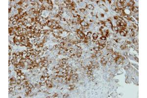 IHC-P Image Immunohistochemical analysis of paraffin-embedded A549 xenograft, using alpha Actinin 4, antibody at 1:500 dilution.