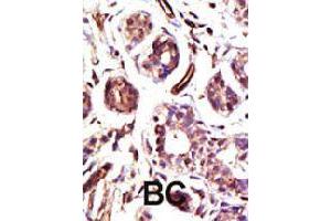 Formalin-fixed and paraffin-embedded human cancer tissue reacted with UBE3A polyclonal antibody  , which was peroxidase-conjugated to the secondary antibody, followed by DAB staining . (ube3a anticorps  (C-Term))