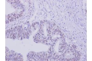 IHC-P Image ZNF45 antibody [N2C3] detects ZNF45 protein at nucleus on human colon carcinoma by immunohistochemical analysis. (ZNF45 anticorps)