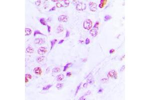 Immunohistochemical analysis of GCN5 staining in human lung cancer formalin fixed paraffin embedded tissue section.