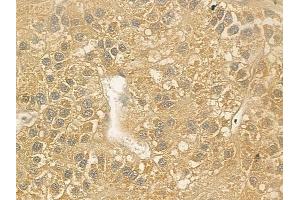 ABIN6262563 and ABIN6276905 at 1/100 staining human hepatocellular carcinoma by IHC-P. (IL2RG anticorps  (N-Term))