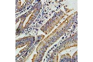Immunohistochemical analysis of PIBF staining in human colon cancer formalin fixed paraffin embedded tissue section. (PIBF1 anticorps)