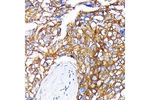 Immunohistochemistry of paraffin-embedded human liver cancer using Leptin Receptor Rabbit mAb (ABIN7268210) at dilution of 1:100 (40x lens). (Leptin Receptor anticorps)