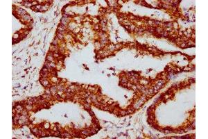IHC image of ABIN7127858 diluted at 1:117 and staining in paraffin-embedded human colon cancer performed on a Leica BondTM system.