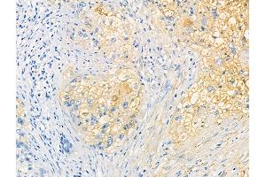 Phospho-XIRP1 (Ser295) Antibody at 1/100 staining Human ovarian cancer by IHC-P.