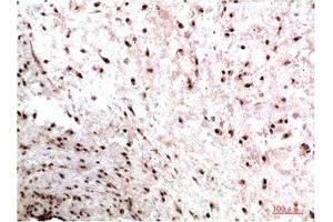 Immunohistochemical analysis of paraffin-embedded Human Colon Carcinoma Tissue using HP-1γ Mouse mAb diluted at 1:200. (CBX3 anticorps)