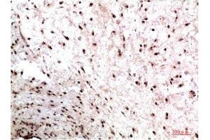 Immunohistochemical analysis of paraffin-embedded Human Colon Carcinoma Tissue using HP-1γ Mouse mAb diluted at 1:200. (CBX3 anticorps)