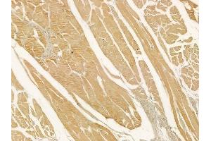 ABIN6262784 and ABIN6278914 at 1/100 staining human tongue carcinoma by IHC-P. (KRT23 anticorps  (N-Term))