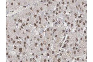 ABIN6267529 at 1/200 staining human liver cancer tissue sections by IHC-P. (SAPK, JNK (pTyr185) anticorps)