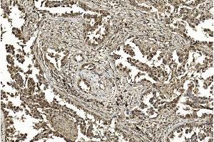 Immunohistochemical analysis of paraffin-embedded Human Lung adenocarcinoma section using Pink1 am1200a. (SUMO1 anticorps)