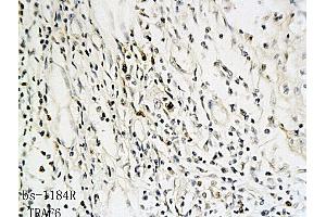 Formalin-fixed and paraffin embedded human oral squamous cell carcinoma labeled with Anti-TRAF6 Polyclonal Antibody, Unconjugated (ABIN738906) followed by conjugation to the secondary antibody and DAB staining