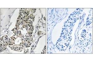 Immunohistochemistry analysis of paraffin-embedded human breast carcinoma tissue, using RIMS4 Antibody. (RIMS4 anticorps  (AA 33-82))