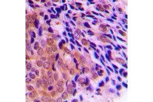 Immunohistochemical analysis of CLOCK staining in human prostate cancer formalin fixed paraffin embedded tissue section.