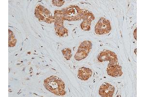 ABIN6269228 at 1/50 staining human breast cancer tissue by IHC-P. (VEGFR2/CD309 anticorps)