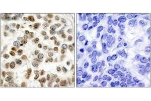 Immunohistochemistry analysis of paraffin-embedded human breast carcinoma tissue, using BRCA1 (Ab-1423) Antibody. (BRCA1 anticorps  (AA 1391-1440))