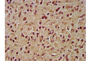 IHC image of ABIN7173964 diluted at 1:400 and staining in paraffin-embedded human glioma performed on a Leica BondTM system. (INPP5B anticorps  (AA 78-178))