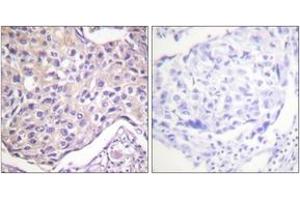 Immunohistochemistry analysis of paraffin-embedded human breast carcinoma, using GRK2 (Phospho-Ser29) Antibody. (GRK2 anticorps  (pSer29))
