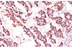 Immunohistochemistry of paraffin-embedded Human thyroid cancer using RPL24 Polyclonal Antibody at dilution of 1:100 (40x lens). (RPL24 anticorps)