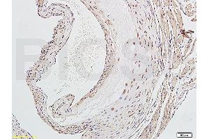 Formalin-fixed and paraffin embedded human endometrium carcinoma labeled with Rabbit Anti-NFKB p65 Polyclonal Antibody (ABIN668961), Unconjugated at 1:200 followed by conjugation to the secondary antibody and DAB staining. (NF-kB p65 anticorps  (AA 51-100))