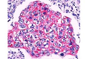 Formalin/paraffin breast ductal carcinoma stained with beta-Catenin antibody.