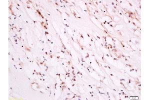 paraformaldehyde-fixed, paraffin embedded human breast carcinoma tissue, Antigen retrieval by boiling in sodium citrate buffer(pH6) for 15min, Block endogenous peroxidase by 3% hydrogen peroxide for 30 minutes, Blocking buffer (normal goat serum) at 37°C for 20min, Antibody incubation with Rabbit Anti-PDK1 (Ser241) Polyclonal Antibody, Unconjugated  at 1:500 overnight at 4°C, followed by a conjugated secondary and DAB staining