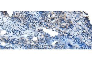 Immunohistochemistry of paraffin-embedded Human cervical cancer tissue using SAA4 Polyclonal Antibody at dilution of 1:35(x200)