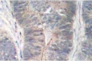 Immunohistochemistry (IHC) analyzes of p-PKR antibody in paraffin-embedded human colon carcinoma tissue. (EIF2AK2 anticorps  (pThr451))