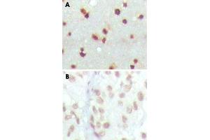 Immunohistochemical analysis of paraffin-embedded human cerebra (A) and lung carcinoma (B) tissue using MDM4 monoclonal antobody, clone 2D10F4 , showing nuclear localization with DAB staining. (MDM4-binding Protein anticorps)